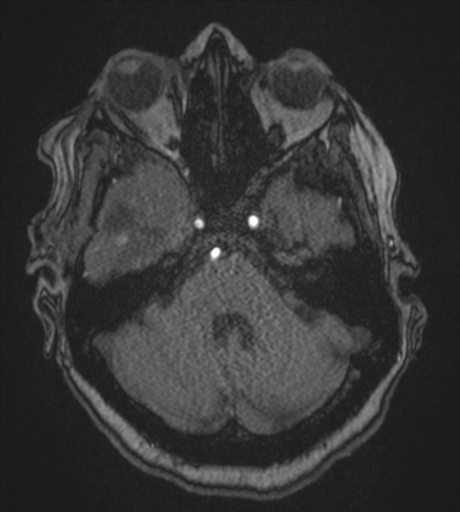 Atypical meningioma (WHO Grade II) (Radiopaedia 54742-60981 Axial MRA 26).png