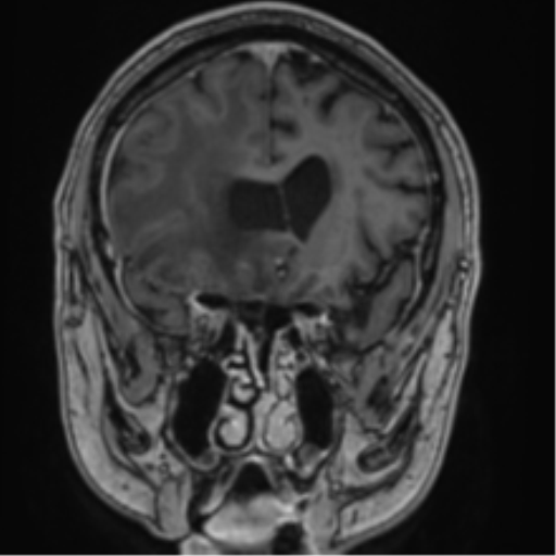 Atypical meningioma (WHO grade II) with brain invasion (Radiopaedia 57767-64729 Coronal T1 C+ 27).png