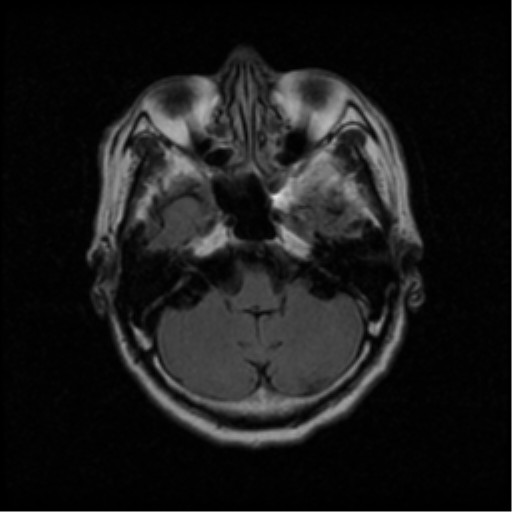 File:Atypical meningioma with skull invasion (Radiopaedia 34357-35648 Axial FLAIR 5).png