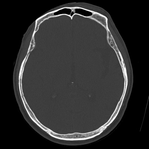 Atypical meningioma with skull invasion (Radiopaedia 34357-35649 Axial bone window 41).png