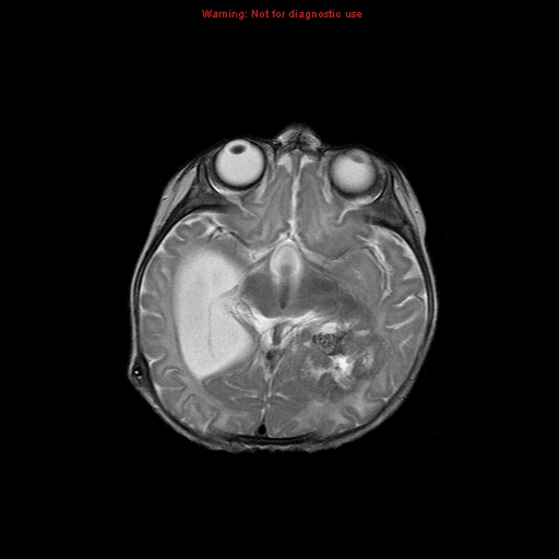 File:Atypical teratoid rhabdoid tumor (Radiopaedia 10712-11183 Axial T2 10).jpg