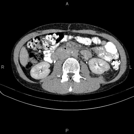 Autoimmune pancreatitis (Radiopaedia 84925-100431 Axial C+ delayed 39).jpg