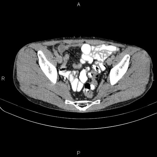 Autoimmune pancreatitis (Radiopaedia 84925-100431 Axial C+ delayed 81).jpg