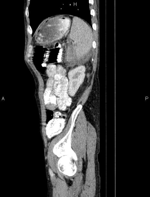 Autoimmune pancreatitis (Radiopaedia 84925-100431 E 80).jpg