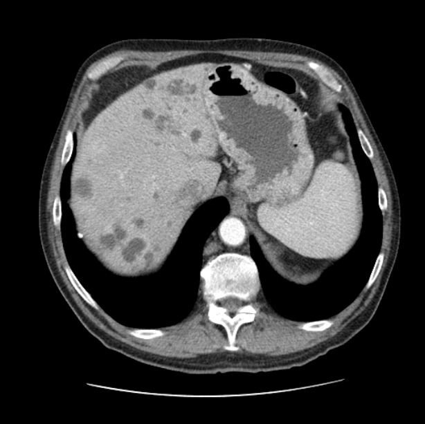 Autosomal dominant polycystic kidney disease (Radiopaedia 27851-28094 B 53).jpg