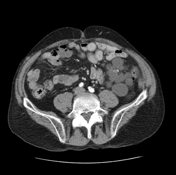 Autosomal dominant polycystic kidney disease (Radiopaedia 27851-28094 B 88).jpg