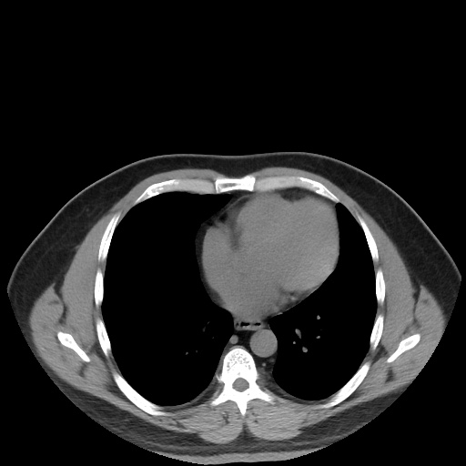 File:Autosomal dominant polycystic kidney disease (Radiopaedia 50259-55612 Axial non-contrast 7).jpg