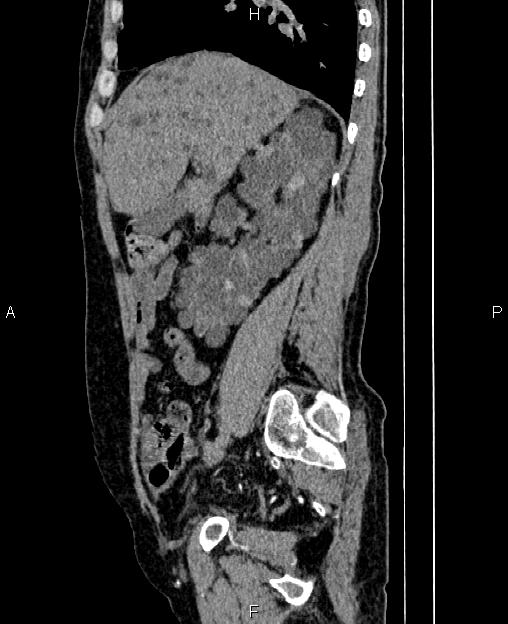Autosomal dominant polycystic kidney disease (Radiopaedia 87830-104287 C 29).jpg