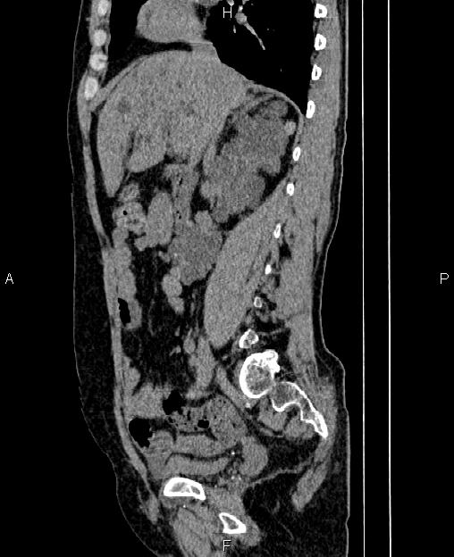 Autosomal dominant polycystic kidney disease (Radiopaedia 87830-104287 C 34).jpg
