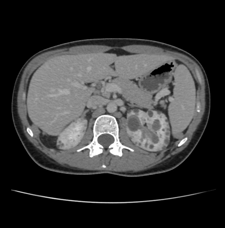 Autosomal dominant polycystic kidney disease - early onset (Radiopaedia 40734-43387 A 18).jpg
