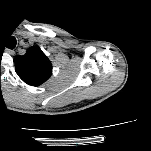 Avascular necrosis after fracture dislocations of the proximal humerus (Radiopaedia 88078-104655 D 40).jpg