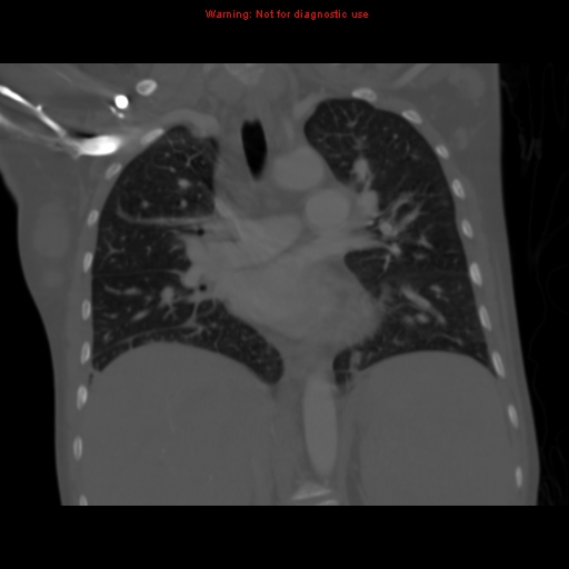 File:Avascular necrosis in sickle cell disease (Radiopaedia 17448-17152 Coronal bone window 68).jpg