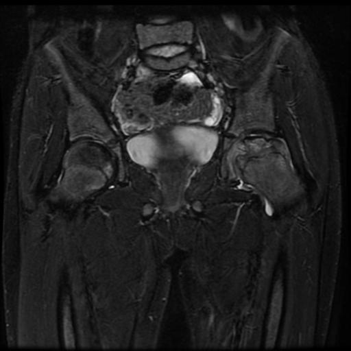 File:Avascular necrosis of the hip (Radiopaedia 29563-30067 Coronal T2 fat sat 7).jpg