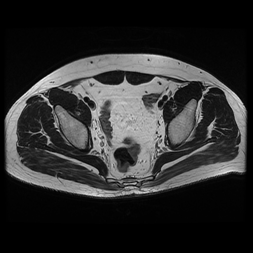 File:Avascular necrosis of the hip (Radiopaedia 61503-69465 T2 11).jpg