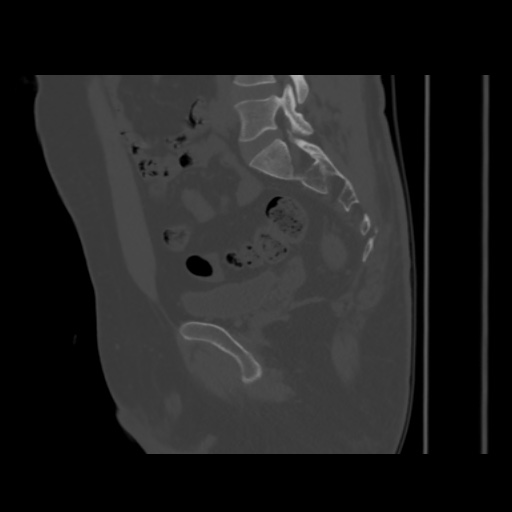 Avascular necrosis of the hip (Radiopaedia 61503-69467 B 27).jpg