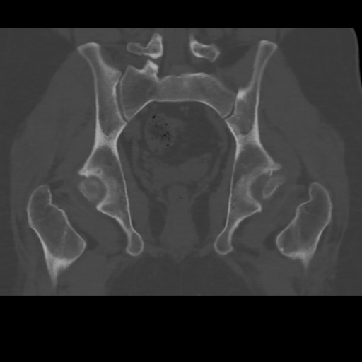 File:Avascular necrosis of the hip (Radiopaedia 61503-69467 Coronal bone window 24).jpg