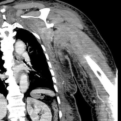 File:Axillary arterial pseudoaneurysm (Radiopaedia 24925-25195 B 16).jpg