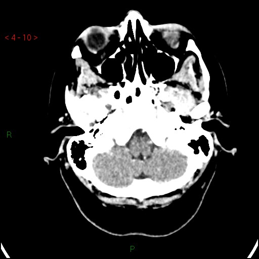 Azygos anterior cerebral artery (Radiopaedia 51987-57833 A 10).jpg