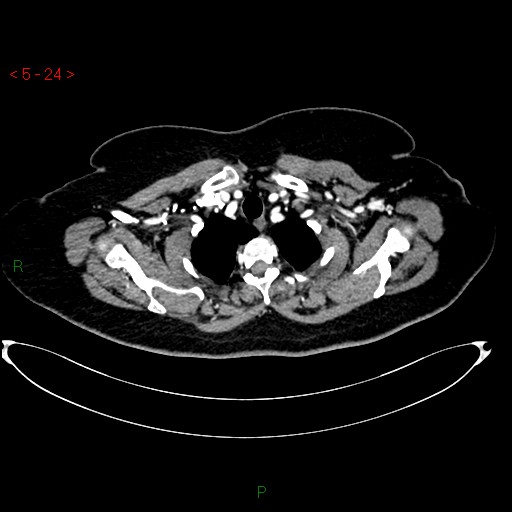 File:Azygos fissure and lobe (Radiopaedia 47620-52278 A 10).jpg