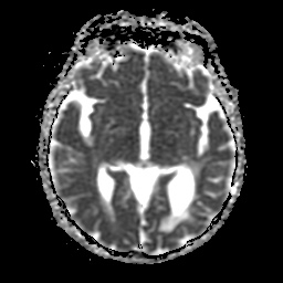 File:Balo concentric sclerosis (Radiopaedia 53875-59982 Axial ADC 12).jpg