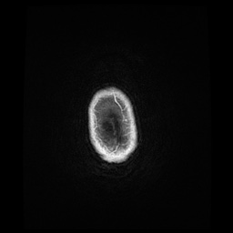 Balo concentric sclerosis (Radiopaedia 53875-59982 Axial LAVA C+ 261).jpg