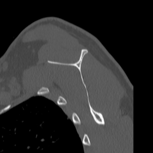 Bankart lesion (Radiopaedia 57256-64185 Sagittal bone window 50).jpg