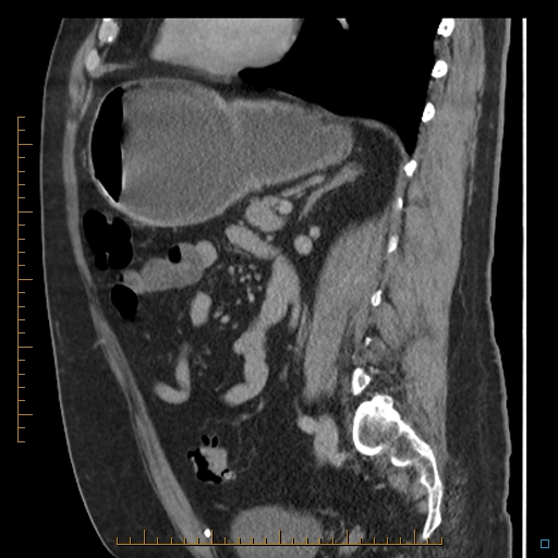 Bariatric balloon causing gastric outlet obstruction (Radiopaedia 54449-60672 C 33).jpg