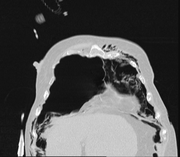 Barotrauma due to mechanical ventilation (Radiopaedia 28079-28336 Coronal lung window 20).jpg