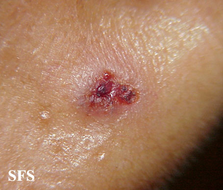 Basal Cell Carcinoma (Dermatology Atlas 155).jpg