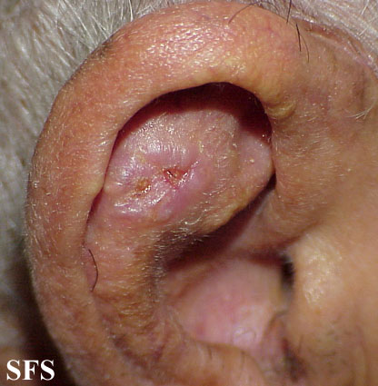 Basal Cell Carcinoma (Dermatology Atlas 58).jpg