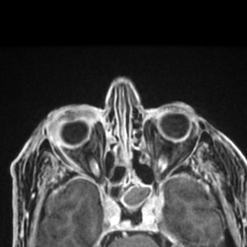 File:Basal cell carcinoma (periorbital) (Radiopaedia 55179-61559 Axial T1 C+ fat sat 12).jpg