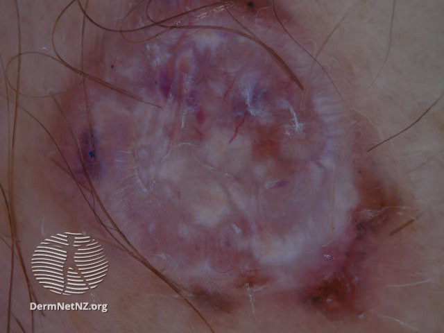 File:Basal cell carcinoma affecting the face (DermNet NZ lesions-bcc-face-1225).jpg