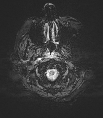 Basal ganglia metastasis (Radiopaedia 78928-91828 Axial SWI 1).png