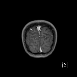 File:Base of skull rhabdomyosarcoma (Radiopaedia 32196-33142 I 67).jpg