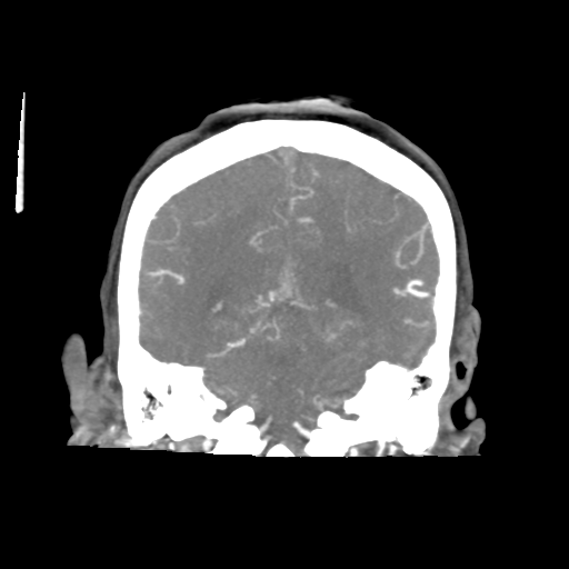 Basilar and bilateral vertebral artery occlusion (Radiopaedia 45592-49723 B 68).png