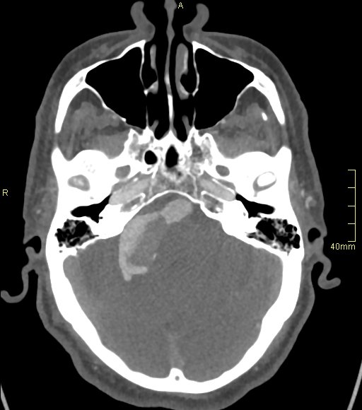 Basilar artery aneurysm (Radiopaedia 56261-62932 A 54).jpg