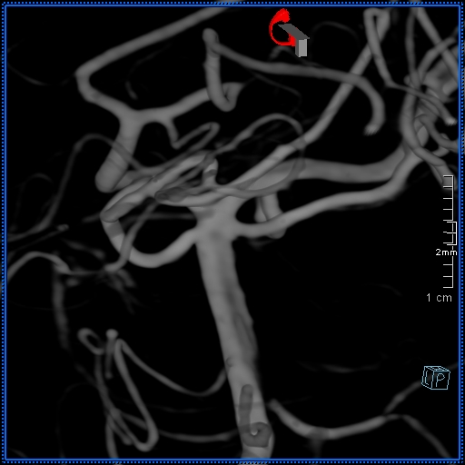 Basilar artery perforator aneurysm (Radiopaedia 82455-99524 3D Left VA 6).jpg