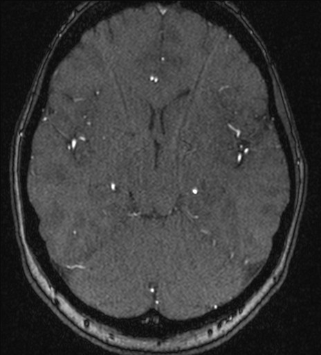 Basilar tip aneurysm (Radiopaedia 26504-26632 MRA 105).jpg
