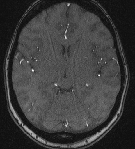 File:Basilar tip aneurysm (Radiopaedia 26504-26632 MRA 118).jpg