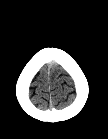 File:Basilar tip aneurysm with coiling (Radiopaedia 53912-60033 Axial 20).jpg