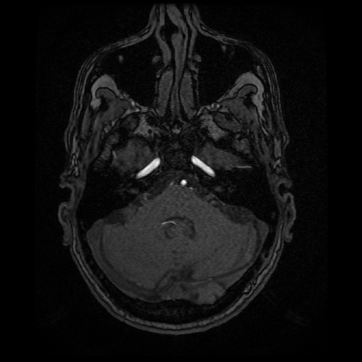 Basilar top and left middle cerebral artery aneurysm (Radiopaedia 61965-70031 Axial MRA 31).jpg