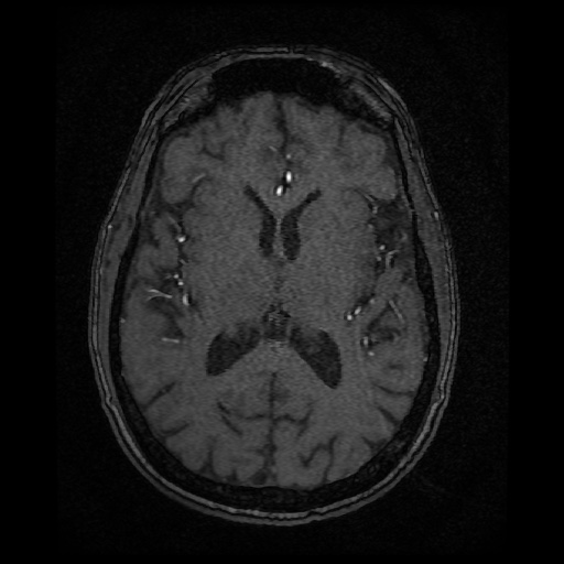 Basilar top and left middle cerebral artery aneurysm (Radiopaedia 61965-70031 Axial MRA 92).jpg