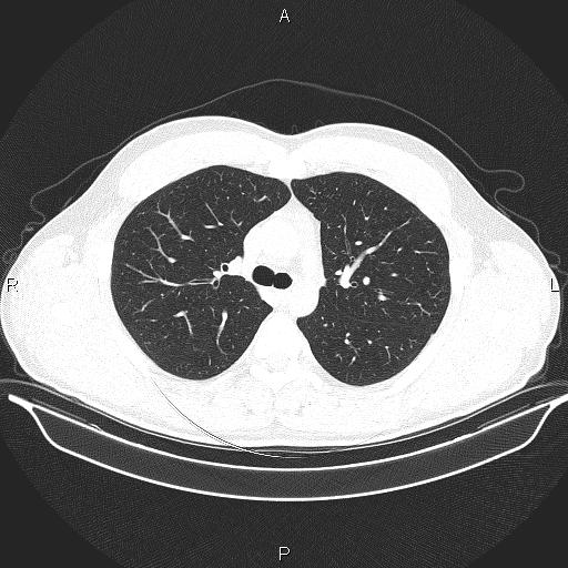 Beam hardening and ring artifacts (Radiopaedia 85323-100915 Axial lung window 29).jpg