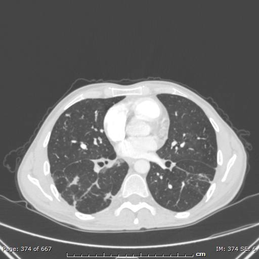 File:Behçet disease (Radiopaedia 44247-47889 Axial lung window 49).jpg