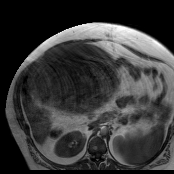 File:Benign seromucinous cystadenoma of the ovary (Radiopaedia 71065-81300 Axial T1 32).jpg