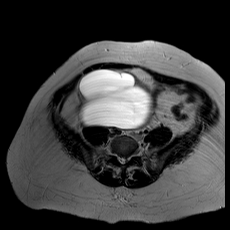 File:Benign seromucinous cystadenoma of the ovary (Radiopaedia 71065-81300 B 16).jpg