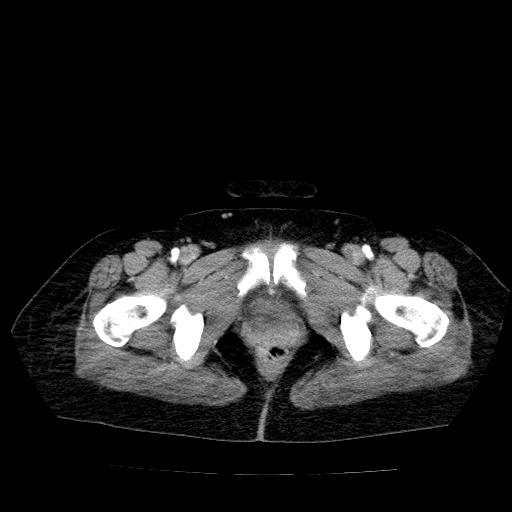 Benign spindle cell tumor - abdominopelvic (Radiopaedia 61300-69212 A 60).jpg