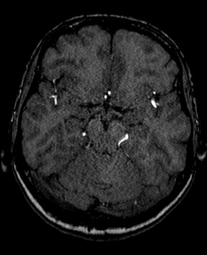 Berry aneurysm of the terminal internal carotid artery (Radiopaedia 88286-104918 Axial TOF 104).jpg