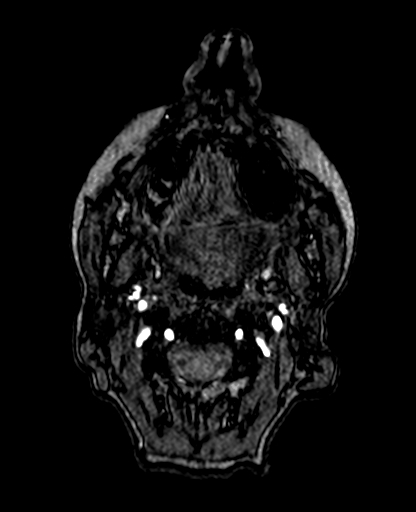 File:Berry aneurysm of the terminal internal carotid artery (Radiopaedia 88286-104918 Axial TOF 2).jpg