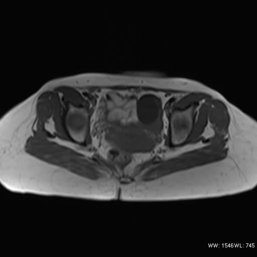 File:Bicornuate uterus- on MRI (Radiopaedia 49206-54297 Axial T1 10).jpg